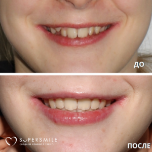 Ещё один результат лечения у ортодонта — уверенная, гармоничная улыбка без скученности и дискомфорта