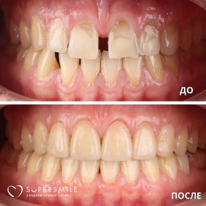 До/После №5985