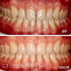 До/После №6148