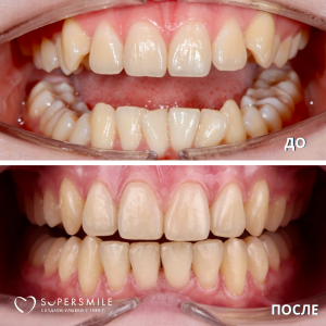 До/После №14227