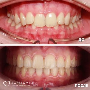 До/После №5849