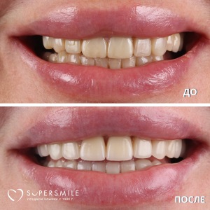 До/После №14126