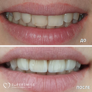 Виниры (до/после)