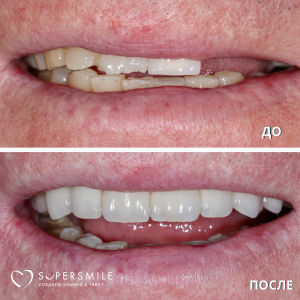 Имплантация с наращиванием кости (до/после)