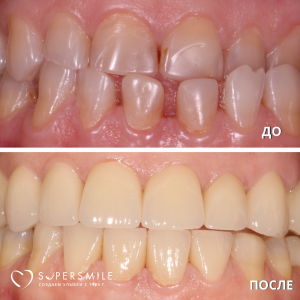 Имплантация/протезирование (до/после)