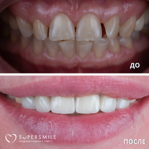 Установка виниров (до/после)