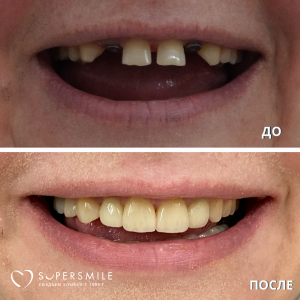 Имплантация/протезирование (до/после)