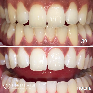 Чистка/терапия (до/после)