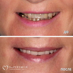 Имплантация/протезирование (до/после)