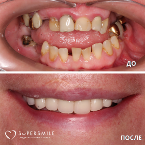 Имплантация/протезирование (до/после)