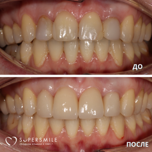 Имплантация/протезирование (до/после)