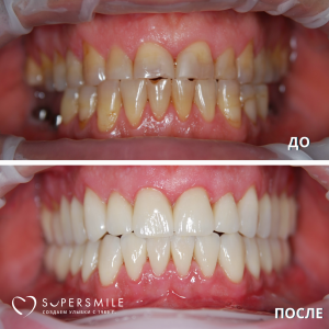 Имплантация и виниры (до/после)