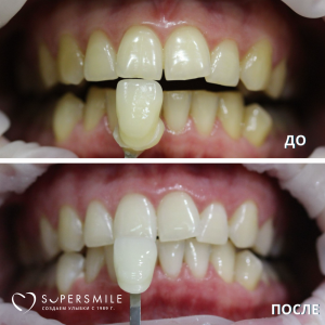 Лечение кариеса/ гигиена (до и после)