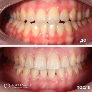 До/После №5981