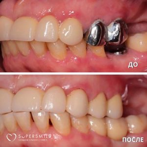 Протезирование зубов (до/после)