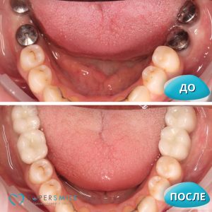Имплантация зубов (до/после)