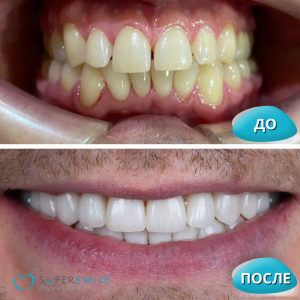 Установка виниров (до/после)