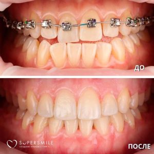 До/После №13940