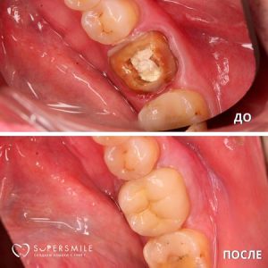 Восстановление зуба коронкой (до/после)