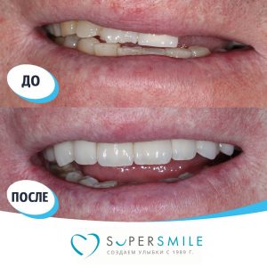 Имплантация с наращиванием кости (до/после)