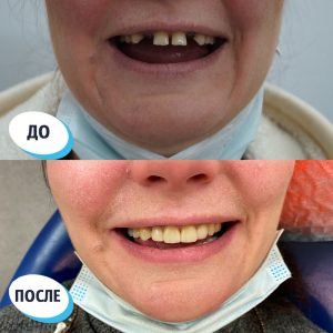 Имплантация/протезирование (до/после)