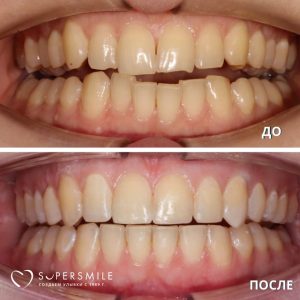 Исправление неправильного прикуса