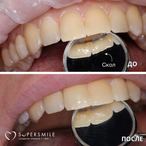 Лечение кариеса