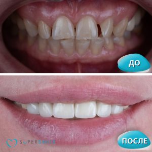 Установка виниров (до/после)