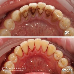 Профессиональная гигиена (до/после)