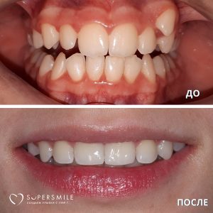 Исправление прикуса (до/после)