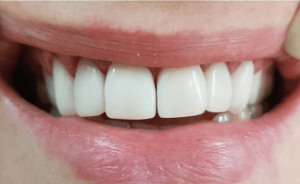 До/После №13965