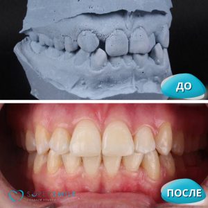 Исправление прикуса (до/после)