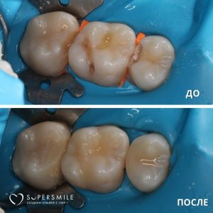 Лечение кариеса