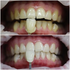 Терапевтическое лечение/гигиена/отбеливание (до/после)