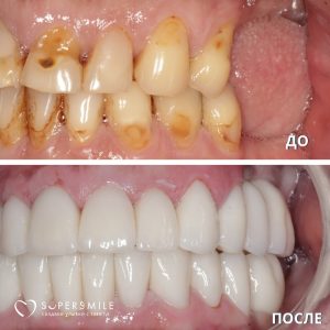 Протезирование с использованием коронок, полукоронок и виниров.