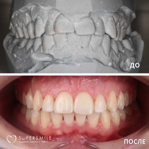 Исправление прикуса (до/после)
