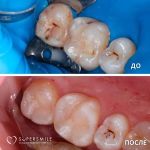 Лечение кариеса (до/после)