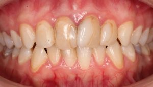 Объемные пломбы на передних зубах.