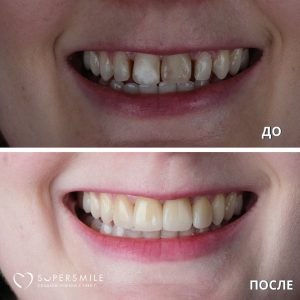 До/После №14155