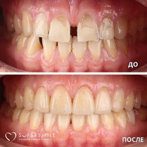 До/После №14238