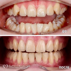 До/После №14237