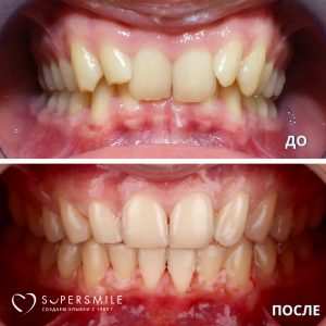 Исправление прикуса (до/после)