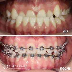 Исправление прикуса (до/после)