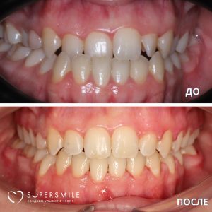 До/После №14230