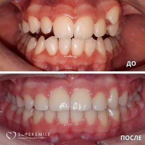 До/После №14229