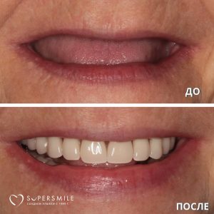 До/После №14300