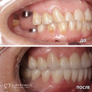 До/После №14303