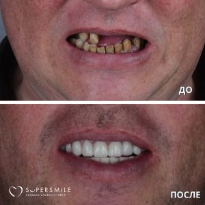 До/После №14302