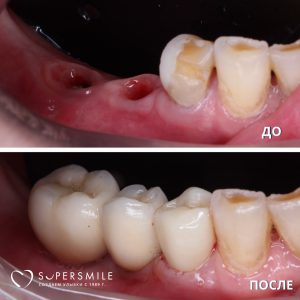 До/После №14305