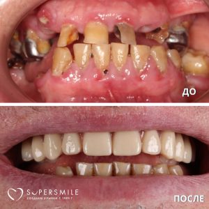 До/После №14306